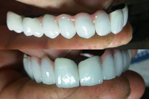 مراحل نصب Snap on Smile در دندانپزشک